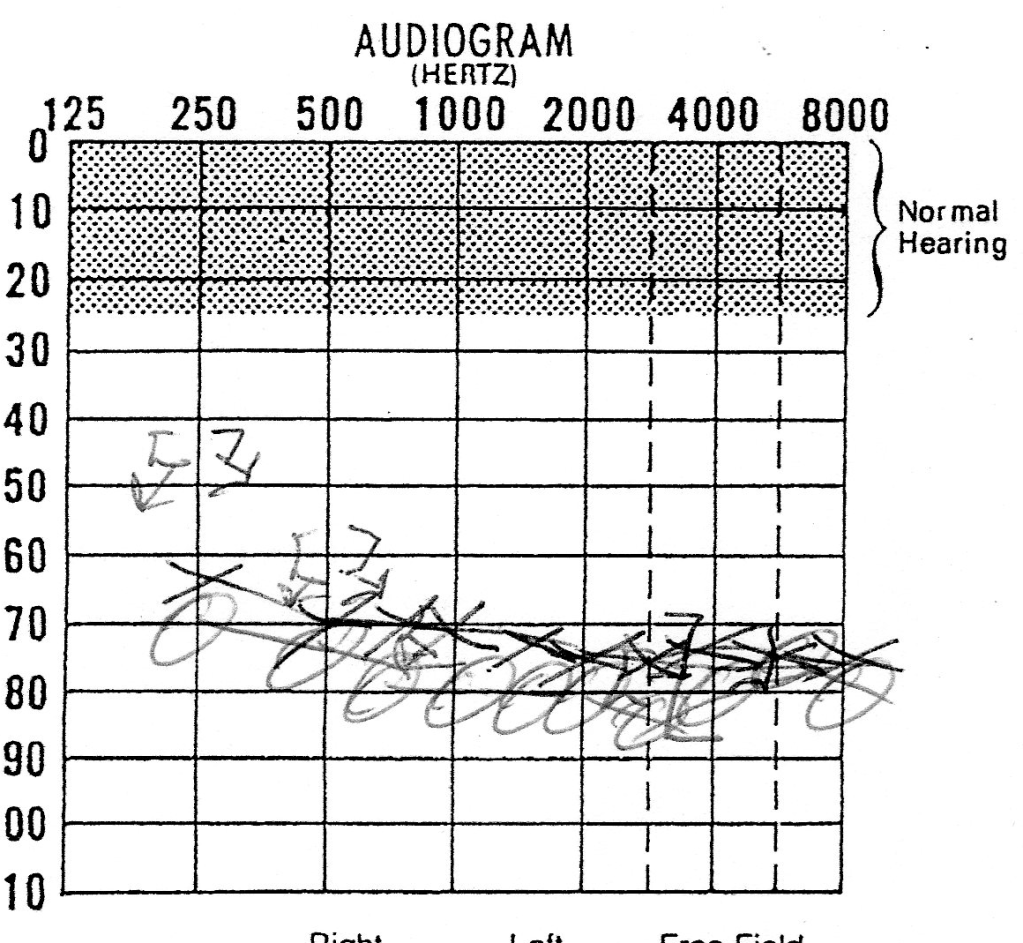hearinglossaudiogram.png