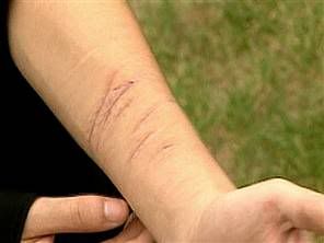 selfinjury - Kendini Yaralama selfinjury